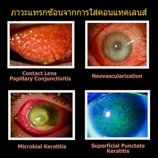 ภาวะแทรกซ้อนที่พบบ่อย