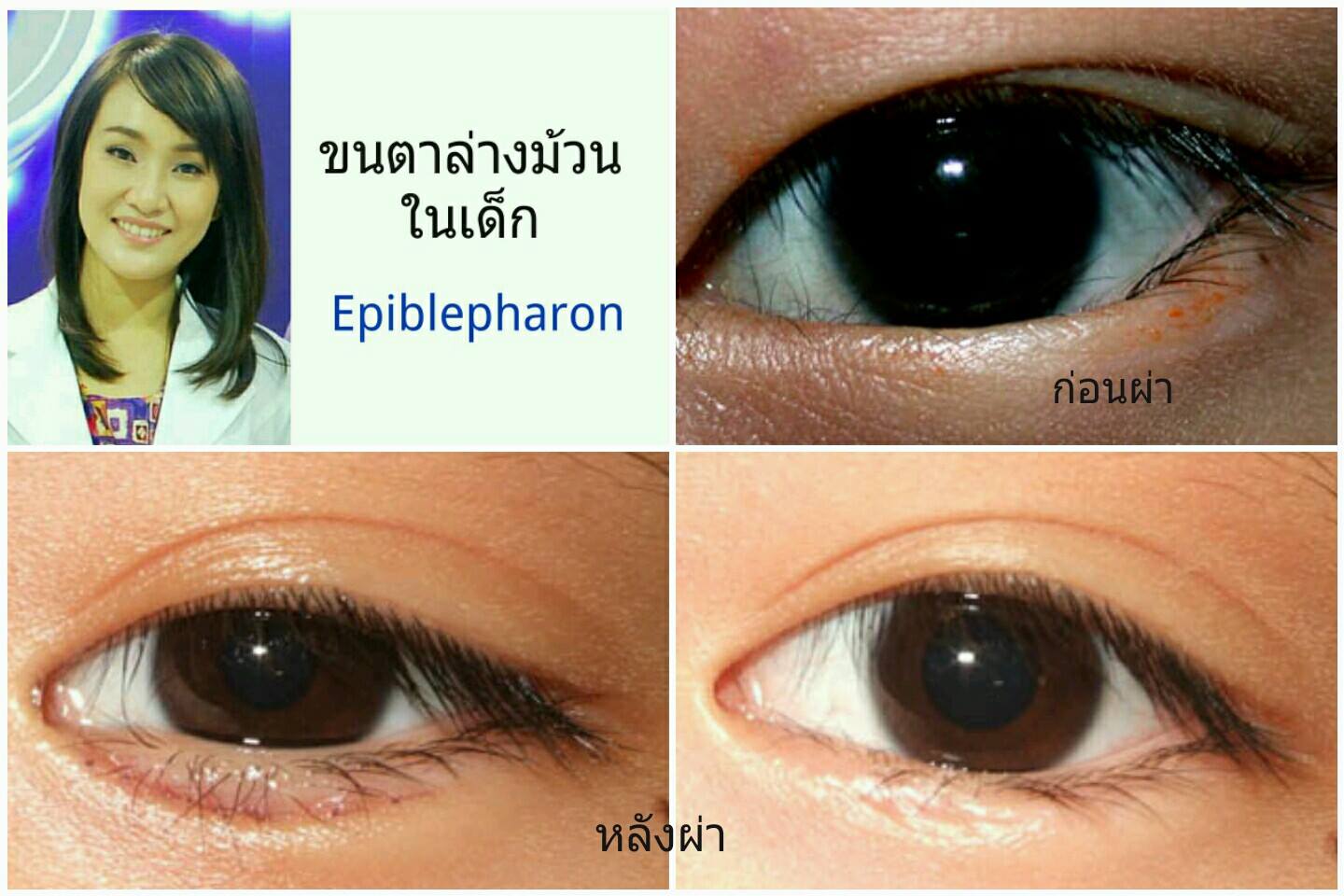ภาวะขนตาล่างม้วนในเด็ก (Epiblepharon)