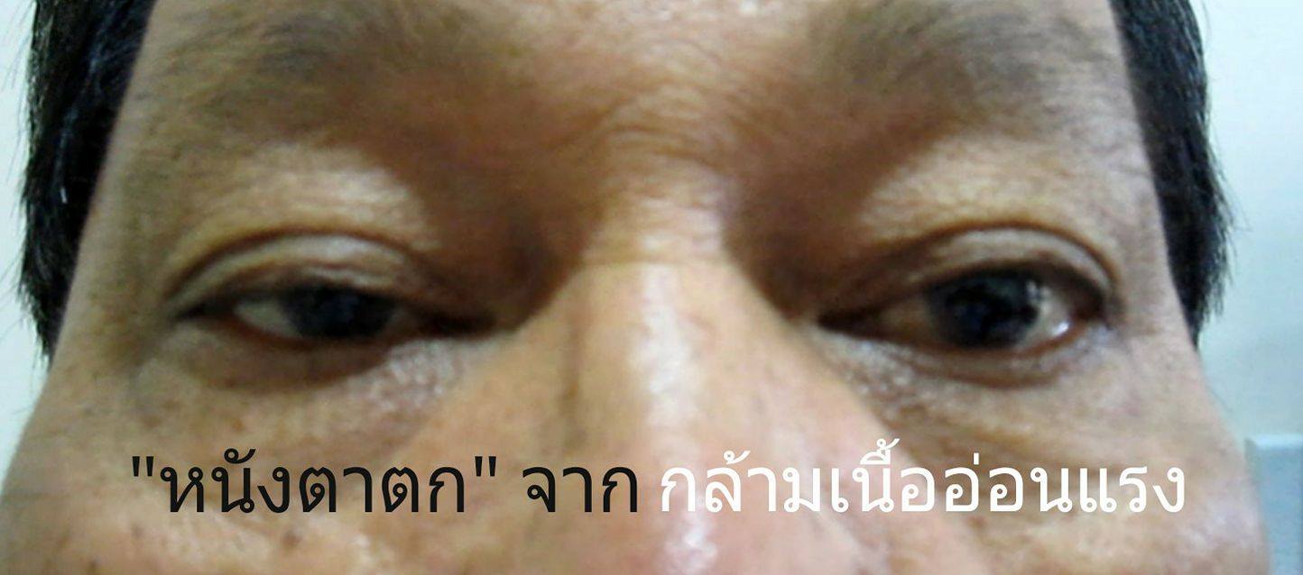 ภาวะหนังตาตกจากโรคกล้ามเนื้ออ่อนแรง Myasthenia Gravis (MG)