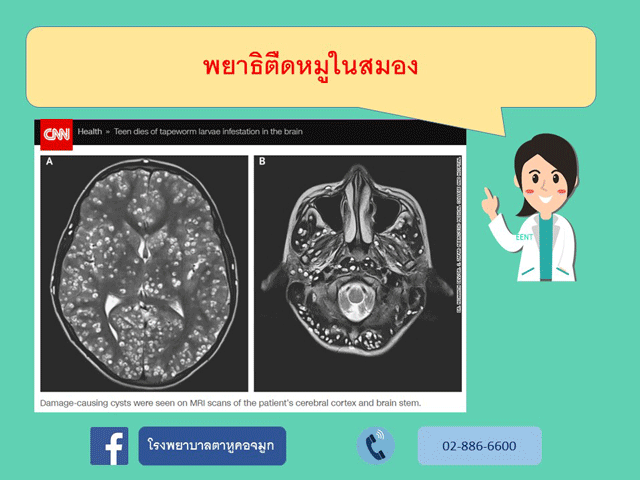 พยาธิตืดหมูในสมอง