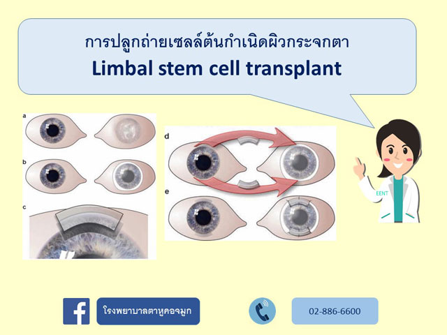 การปลูกถ่ายเซลล์ต้นกำเนิดผิวกระจกตา