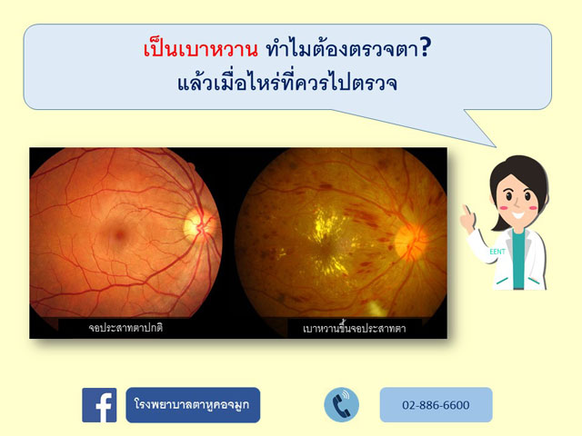 ภาวะเบาหวานขึ้นจอประสาทตา
