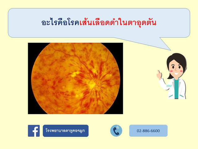 เส้นเลือดดำในตาอุดตัน