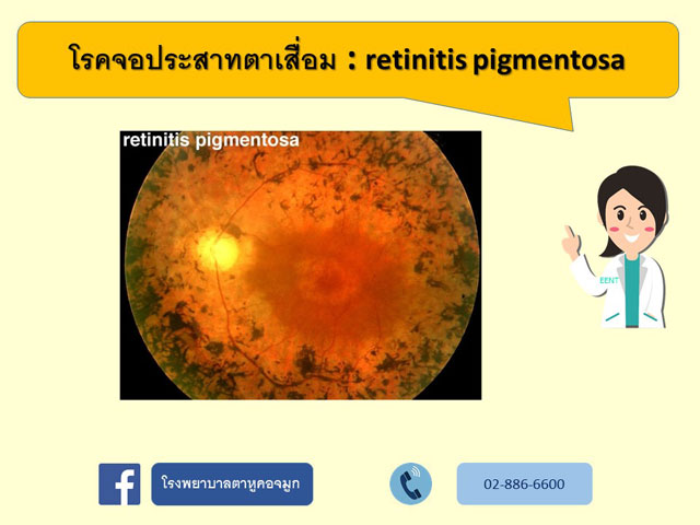 Retinitis