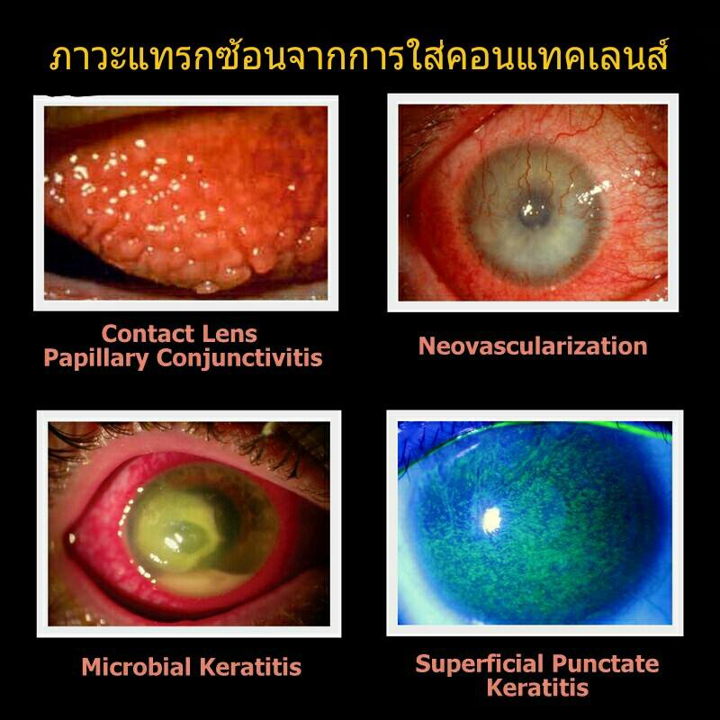 ภาวะแทรกซ้อนที่พบบ่อย จากการใส่คอนแทคเลนส์