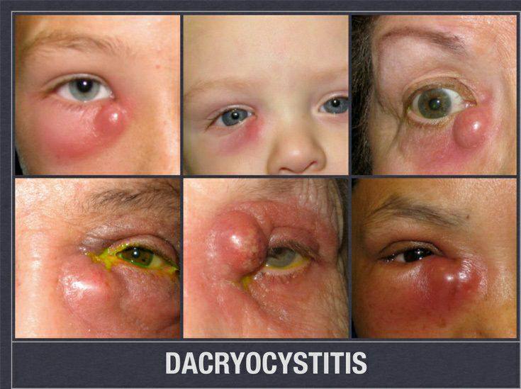 ภาวะถุงน้ำอักเสบติดเชื้อ (Acute dacryocystitis)