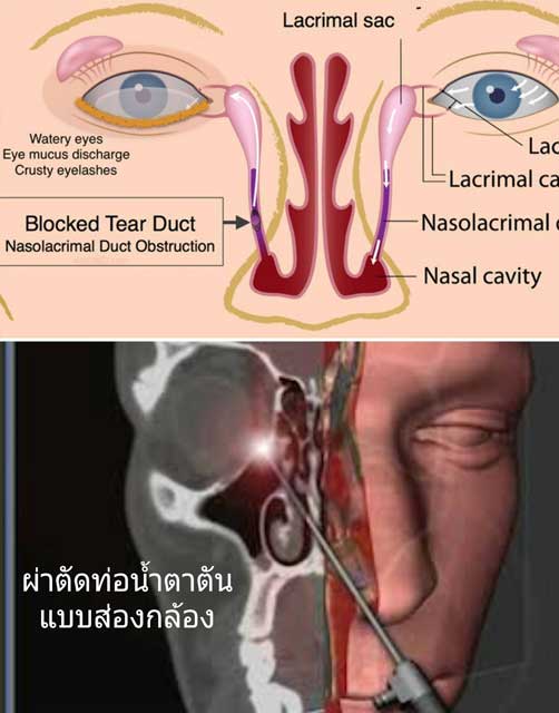 การแก้ไขภาวะท่อน้ำตาตันด้วยการผ่าตัด