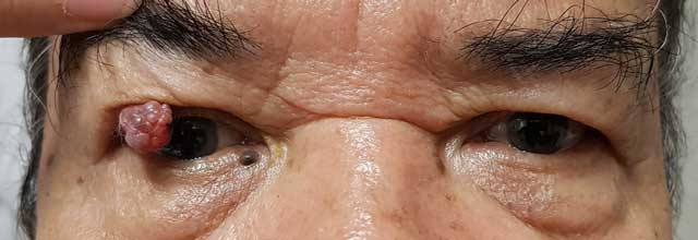 มะเร็งผิวหนังรอบดวงตา