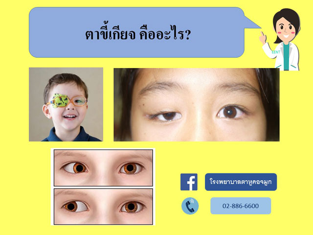 ไขข้อข้องใจเรื่องตาขี้เกียจ