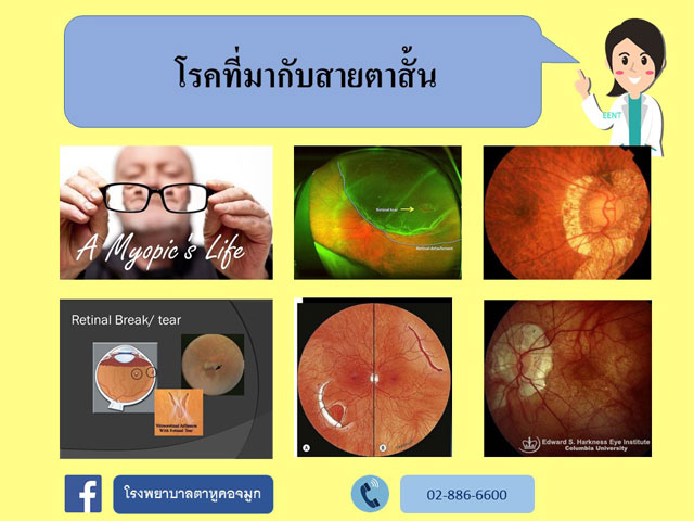 โรคตาที่มากับสายตาสั้น