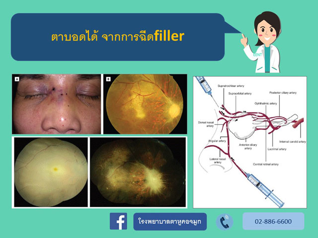 ตาบอดจาก