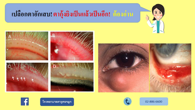 เปลือกตาอักเสบ