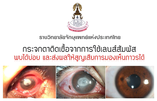 กระจกตาติดเชื้อจากเชื้อปรสิต