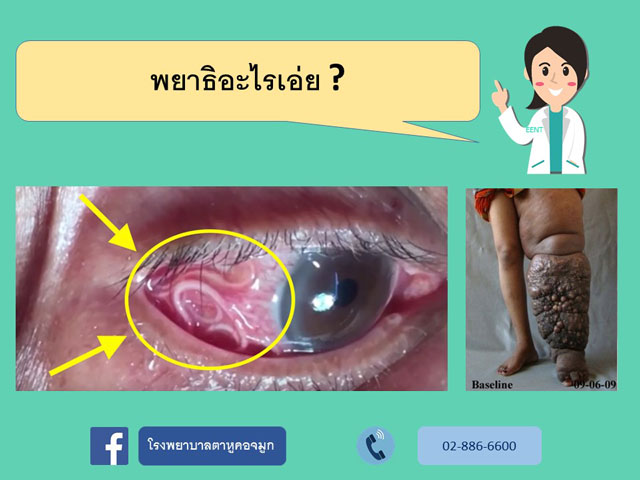 พยาธิอะไรเอ่ย?