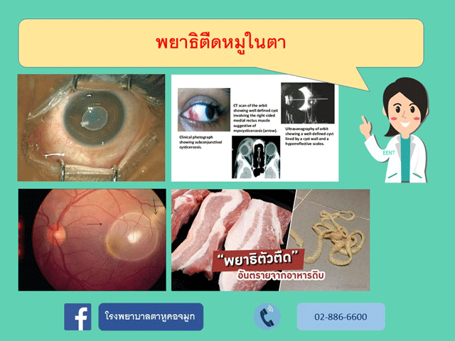 พยาธิตืดหมูในตา