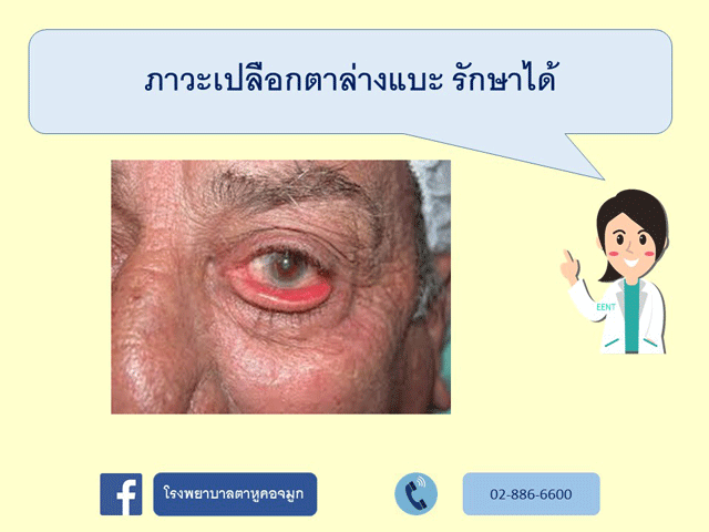 ภาวะเปลือกตาล่างแบะ