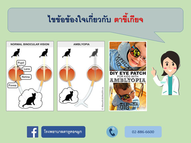 ไขข้อข้องใจเรื่องตาขี้เกียจ