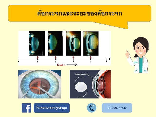 ต้อกระจกและระยะของต้อกระจก