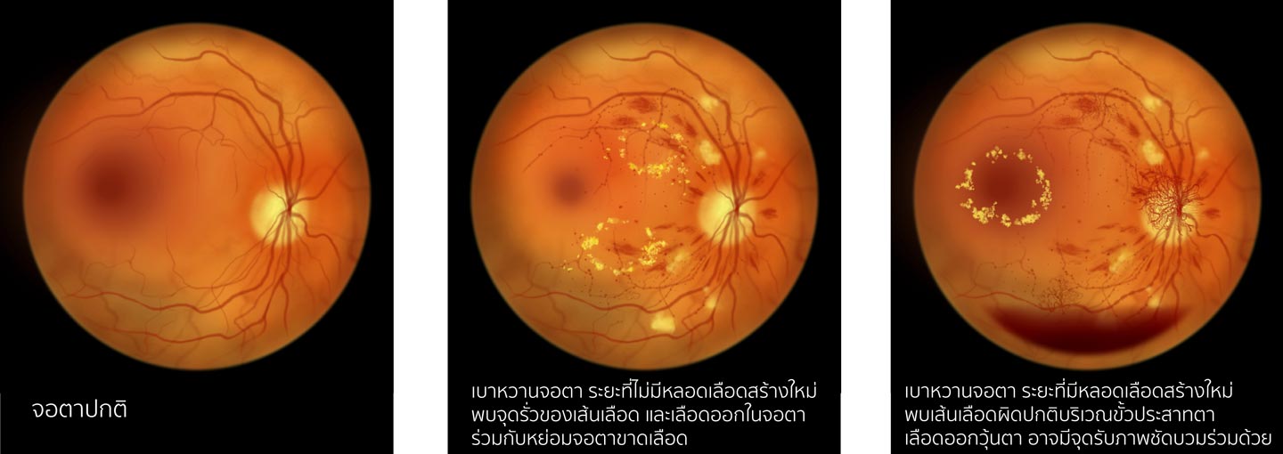 โรคเบาหวานขึ้นจอตา