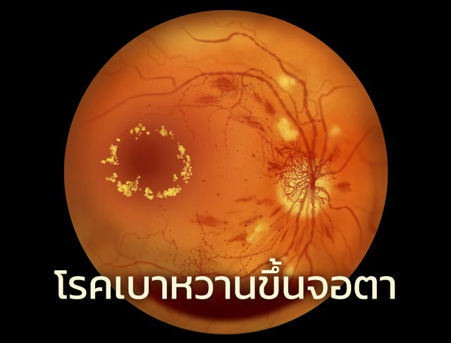 โรคเบาหวานขึ้นจอตา