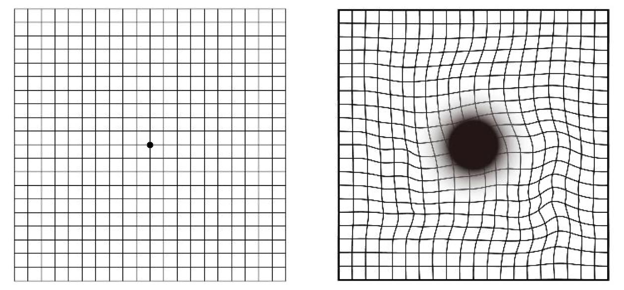 ทดสอบการมองเห็นด้วยแผ่นภาพแอมสเลอร์