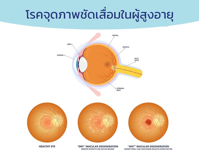 โรคจุดภาพชัดเสื่อมในผู้สูงอายุ